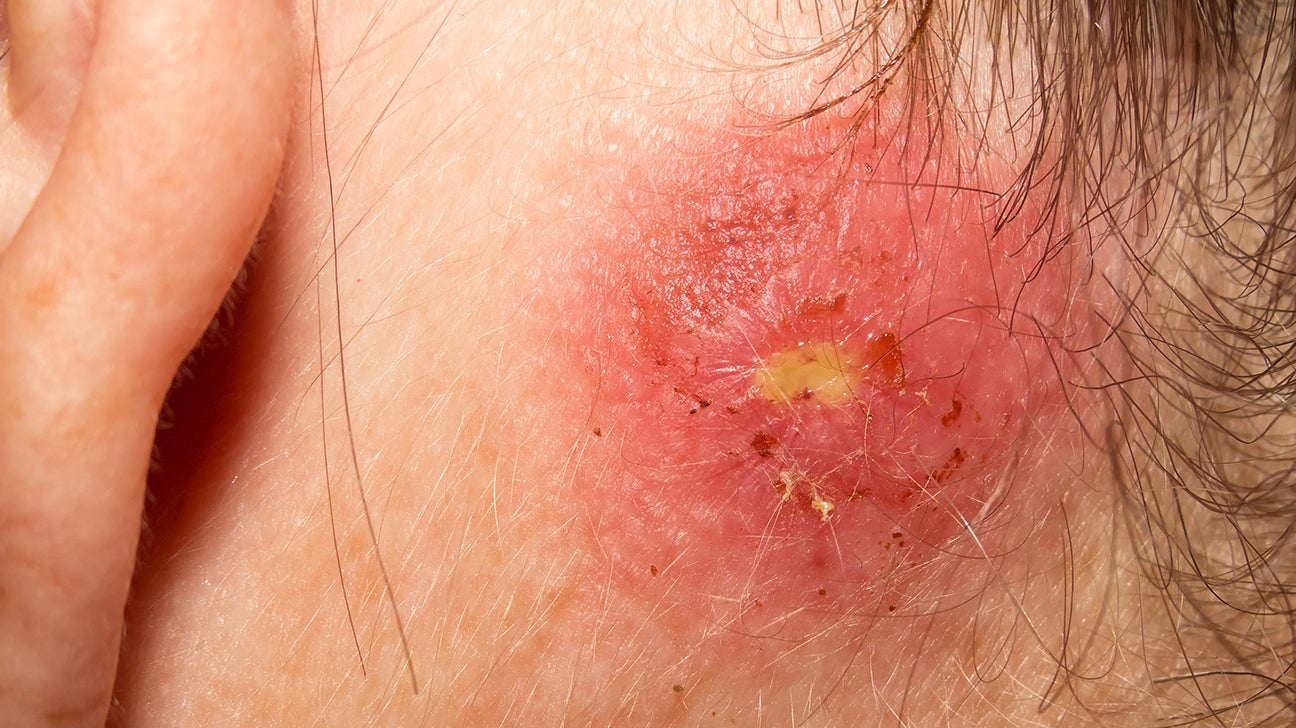 Staph Pores and skin An infection Remedies – Is There A Remedy For Staph?