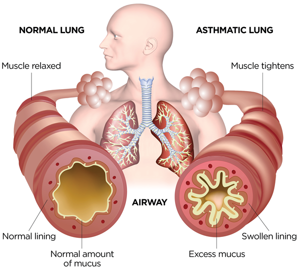 Step Up Remedy for Bronchial asthma